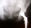 Avoiding the Dangers of Metal Hip Implants