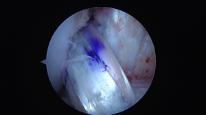 ACL Injuries Arlington VA