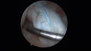 ACL Injuries Arlington VA