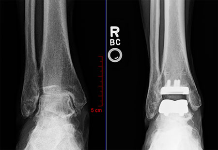 X-ray images before and after total ankle replacement surgery