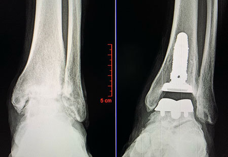 X-ray images before and after total ankle replacement surgery