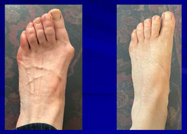 Woman's foot before and after bunion correction surgery