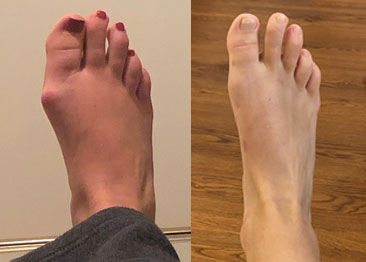 Woman's foot before and after bunion correction surgery