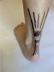 Close-up of Achilles tendon at back of ankle