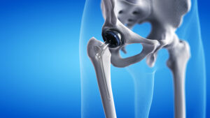 3D rendered illustration of hip replacement