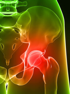 3D rendered anatomy illustration of painful hip joint