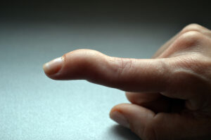 Close-up of a mallet finger injury