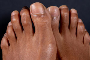 Close-up of woman's feet with hammertoes