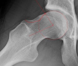 Right hip showing severe cam-type FAI with an alpha angle of 80 degrees