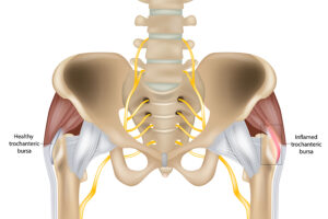 Diagram of hip joint illustrating signs of trochanteric bursitis of the hip