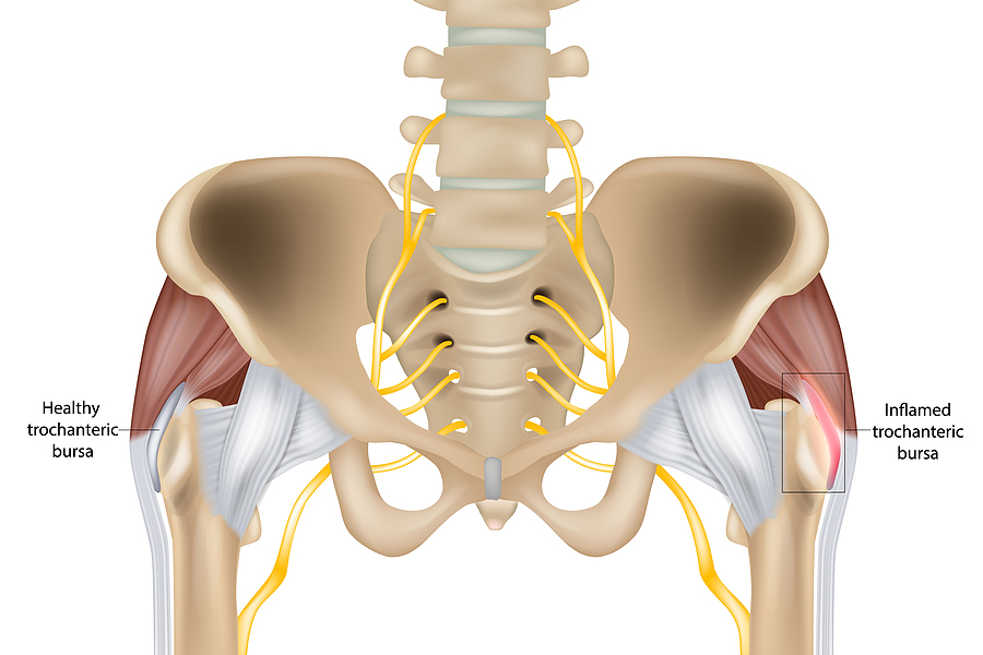 IT Bands and Hip Bursitis